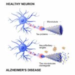 Healthy cell and neurons with AD disease